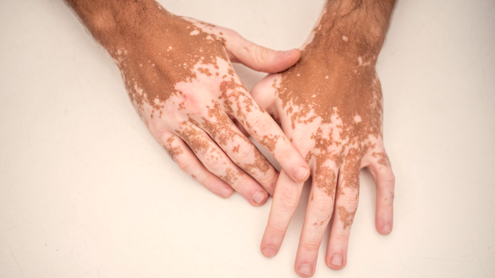 Vitiligo.jpg